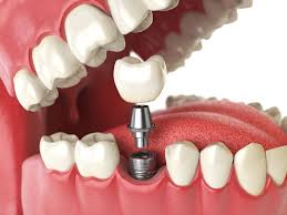 G. K DENTAL CLINIC ORTHODONTIC AND IMPLANT CENTRE NADUVANNUR